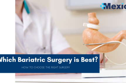 Which Bariatric Surgery is Best