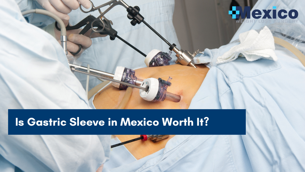 Is Gastric Sleeve in Mexico Worth It